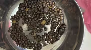 Doctors remove 418 stones from elderly man