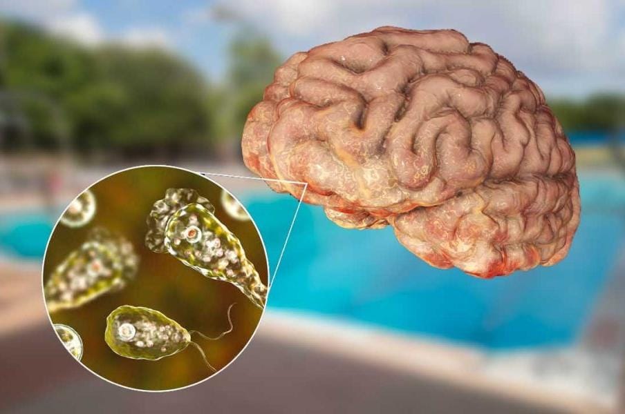One more death; 3 people have died of amoebic encephalitis in the last 2 months.